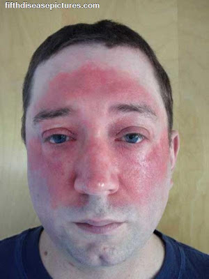 Steroid rosacea elidel